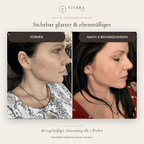 VITARA Micro Needling Set - Anti - Aging Kollagen Falten | VitaraSkin - Vitara Skin | Micro - Needling Infusion für Zuhause!