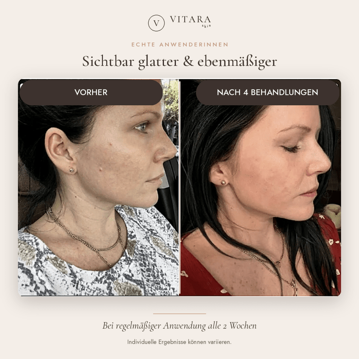 VITARA Micro Needling Set - Anti - Aging Kollagen Falten | VitaraSkin - Vitara Skin | Micro - Needling Infusion für Zuhause!
