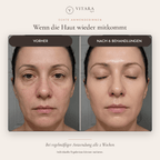 VITARA Micro Needling Set - Anti - Aging Kollagen Falten | VitaraSkin - Vitara Skin | Micro - Needling Infusion für Zuhause!