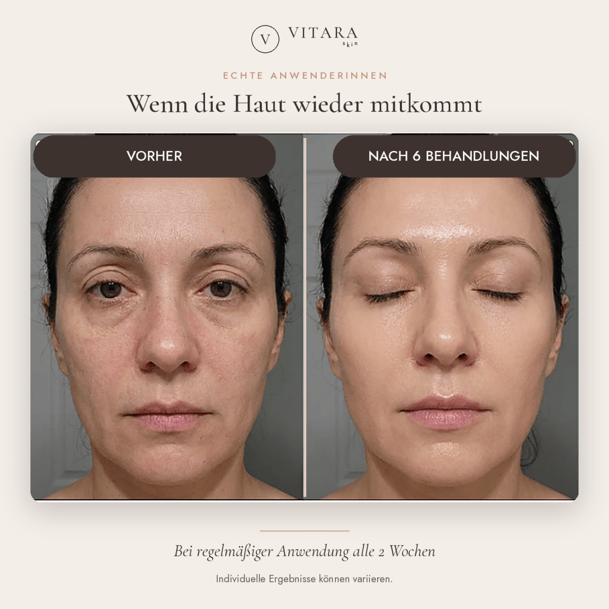 VITARA Micro Needling Set - Anti - Aging Kollagen Falten | VitaraSkin - Vitara Skin | Micro - Needling Infusion für Zuhause!
