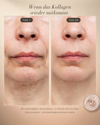 Vitara Skin – Micro-Needling Infusion Set für Zuhause - Vitara Skin | Micro-Needling Infusion für Zuhause!