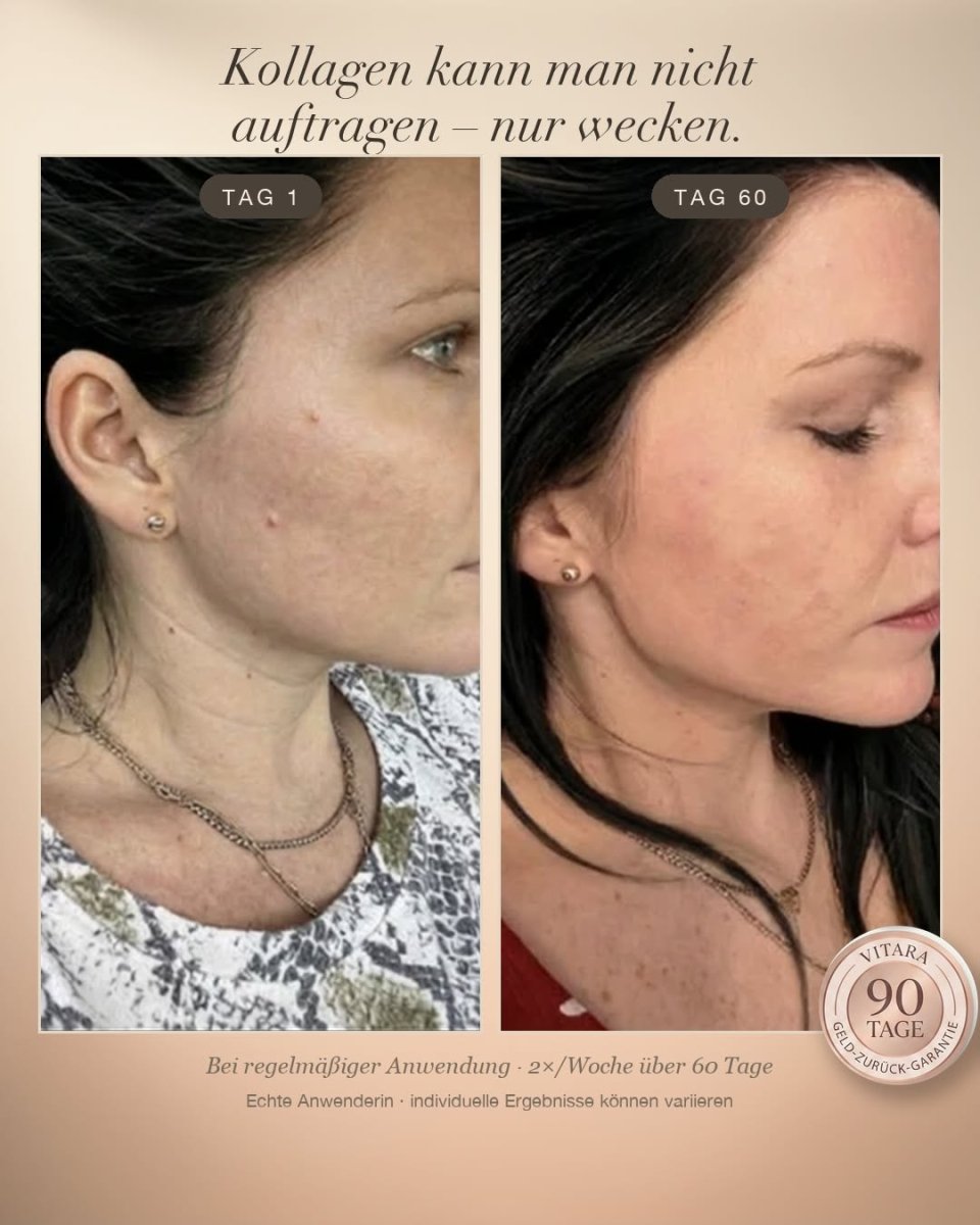 Vitara Skin – Micro-Needling Infusion Set für Zuhause - Vitara Skin | Micro-Needling Infusion für Zuhause!